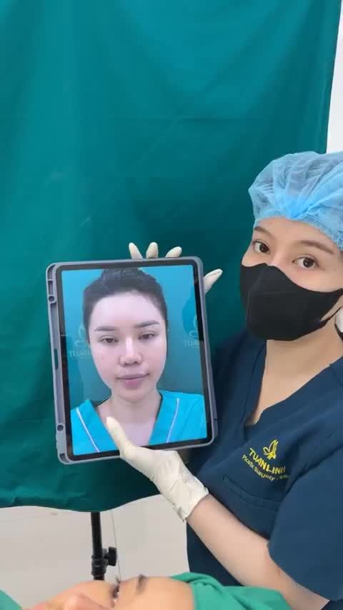 Case mũi cấu trúc sửa lại dáng mũi tự nhiên cho chị gái .