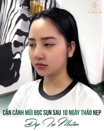 MŨI BỌC SỤN GIÁ CHỈ 1X TRIỆU  10 NGÀY MŨI ĐẸP TỰ NHIÊN.
