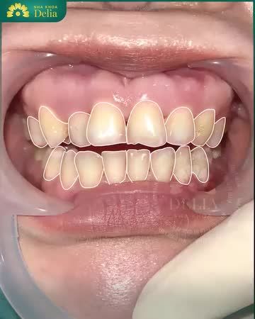 Chỉ sau 3 buổi hẹn, chị đã hoàn toàn hài lòng với nụ cười 20 răng sứ Emax trắng trong, sáng bóng tự nhiên tại nha khoa Delia