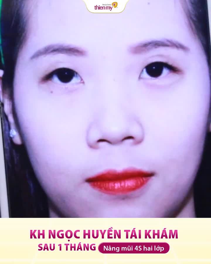 Gặp lại khách hàng sau 1 tháng nâng mũi 4s 2 lớp, vẫn là gương mặt ấy nhưng nay xinh hơn, thu hút hơn nhờ chiếc mũi cao thon, hài hòa với đường nét trên gương mặt.