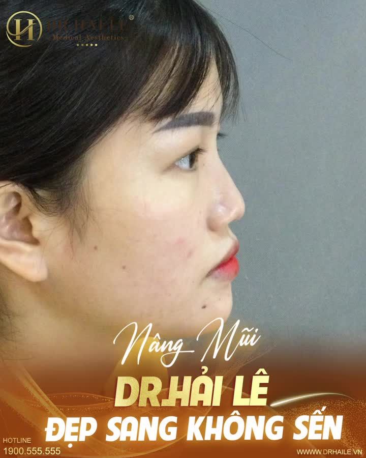 Muốn sở hữu vẻ đẹp hoàn hảo, tại sao bạn không nâng mũi ngay hôm nay tại Dr.Hải Lê?