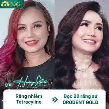 TOP 5 CA BỌC RĂNG SỨ THAY ĐỔI NGOẠN MỤC NHẤT