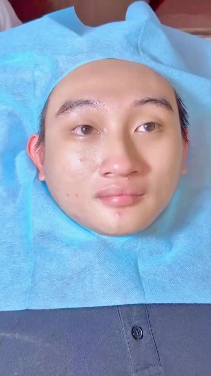 QUÁ ĐÃ: Bác sĩ Thẩm mỹ Da JW LẤP ĐẦY sẹo rỗ LÂU NĂM ăn sâu vào da cho chàng trai GenZ  TIẾT KIỆM 3.5 TRIỆU, để sở hữu ngay Làn da xinh căng bóng tại đây: