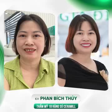 TOP 6 HÀM RĂNG XẤU THAY ĐỔI CÀNG SỚM CÀNG TỐT