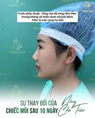 Đến Tuấn Linh nâng mũi chỉ có đẹp và Siêu đẹp = Lại một Mỹ Nhân bước ra từ Tuấn Linh nè!!