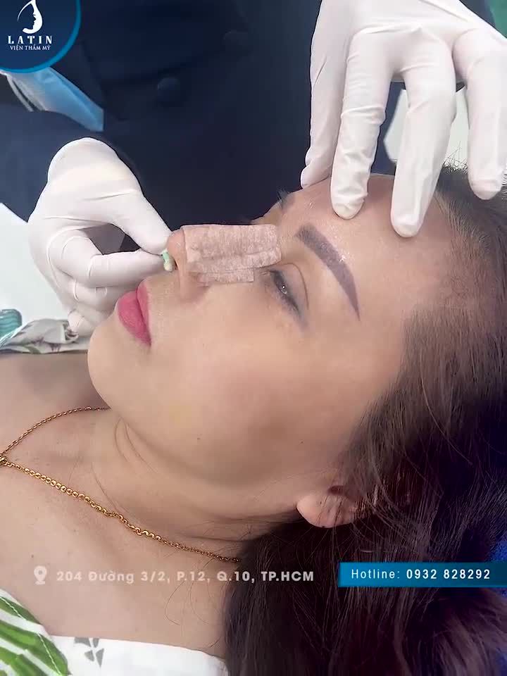 Mũi 10 năm sửa lại đẹp như mới 7 ngày chưa tháo nẹp không sưng không bầm Cùng xem cận cảnh dáng mũi vừa mới mở nẹp nhé cả nhà!