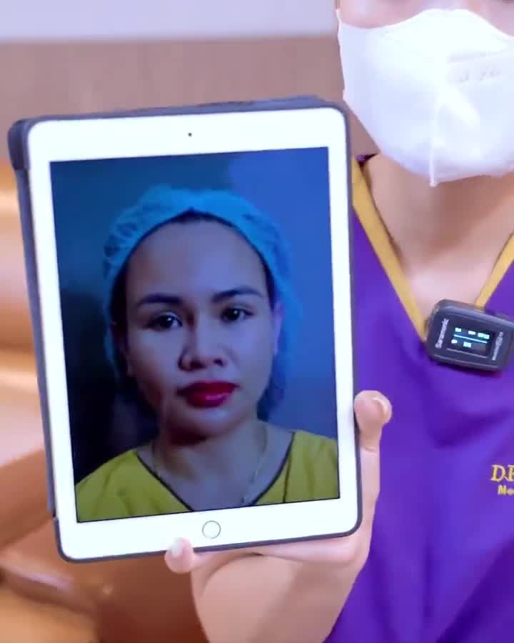 Biến chứng mí lỗi hỏng căng, nhức, mỏi mắt, chảy nước mắt... đã được khắc phục hoàn toàn sau 45 phút khách hàng đến với Dr.Hải Lê