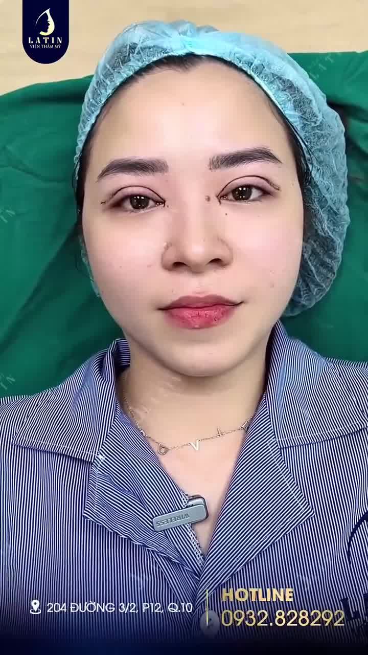 Combo Cắt mí 4D - Mở góc mắt trong vừa hoàn thành