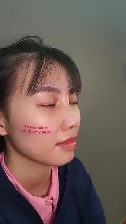 MỘT PHIÊN BẢN HOÀN TOÀN KHÁC SAU NÂNG MŨI ALINE