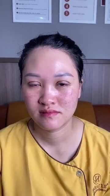 Mắt bệnh lý bên to bên nhỏ nhược cơ bẩm sinh được Dr.Hải Lê HCM chỉnh hình thành công như thế nào? Theo dõi ngay
