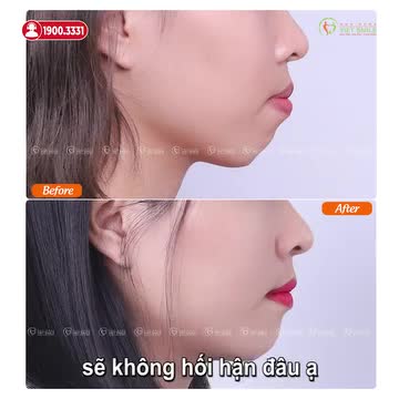NIỀNG RĂNG HẾT HÔ, TỰ TIN CƯỜI XINH VỚI MẮC CÀI SỨ TỰ ĐỘNG