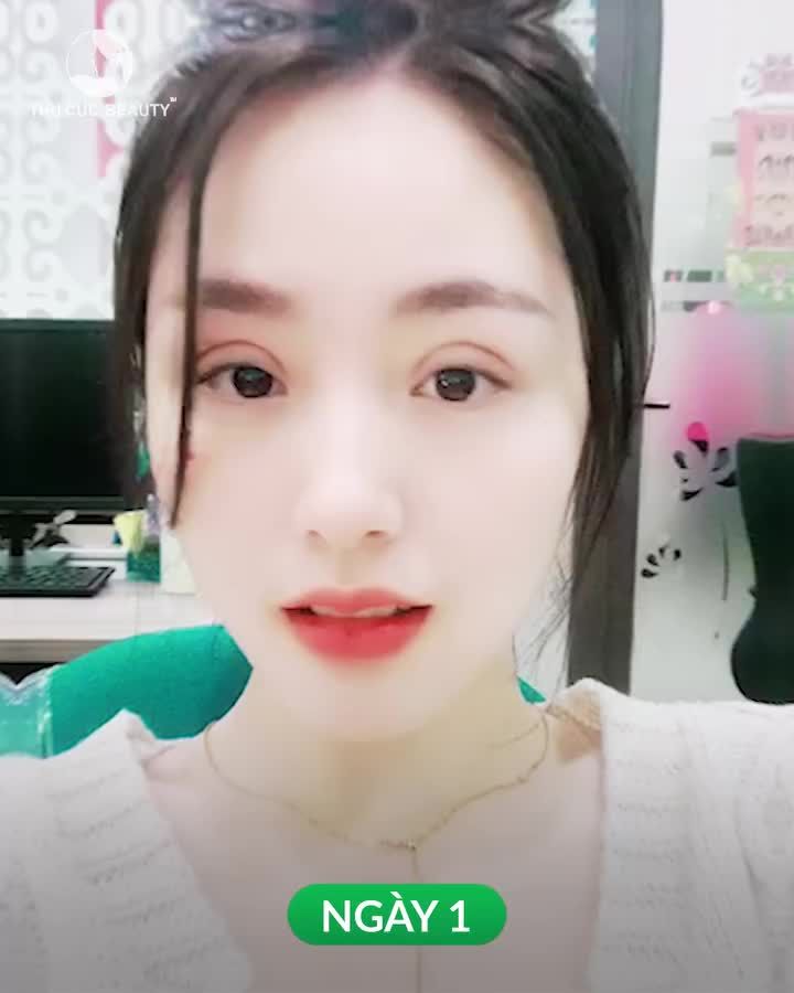 Xóa sổ tình trạng mí lót, da chùng  Chọn Mắt TC Không chảy máu. Không nghỉ dưỡng An toàn. Vô khuẩn tuyệt đối 3 ngày hồi phục sở hữu ngay đôi mắt sắc nét