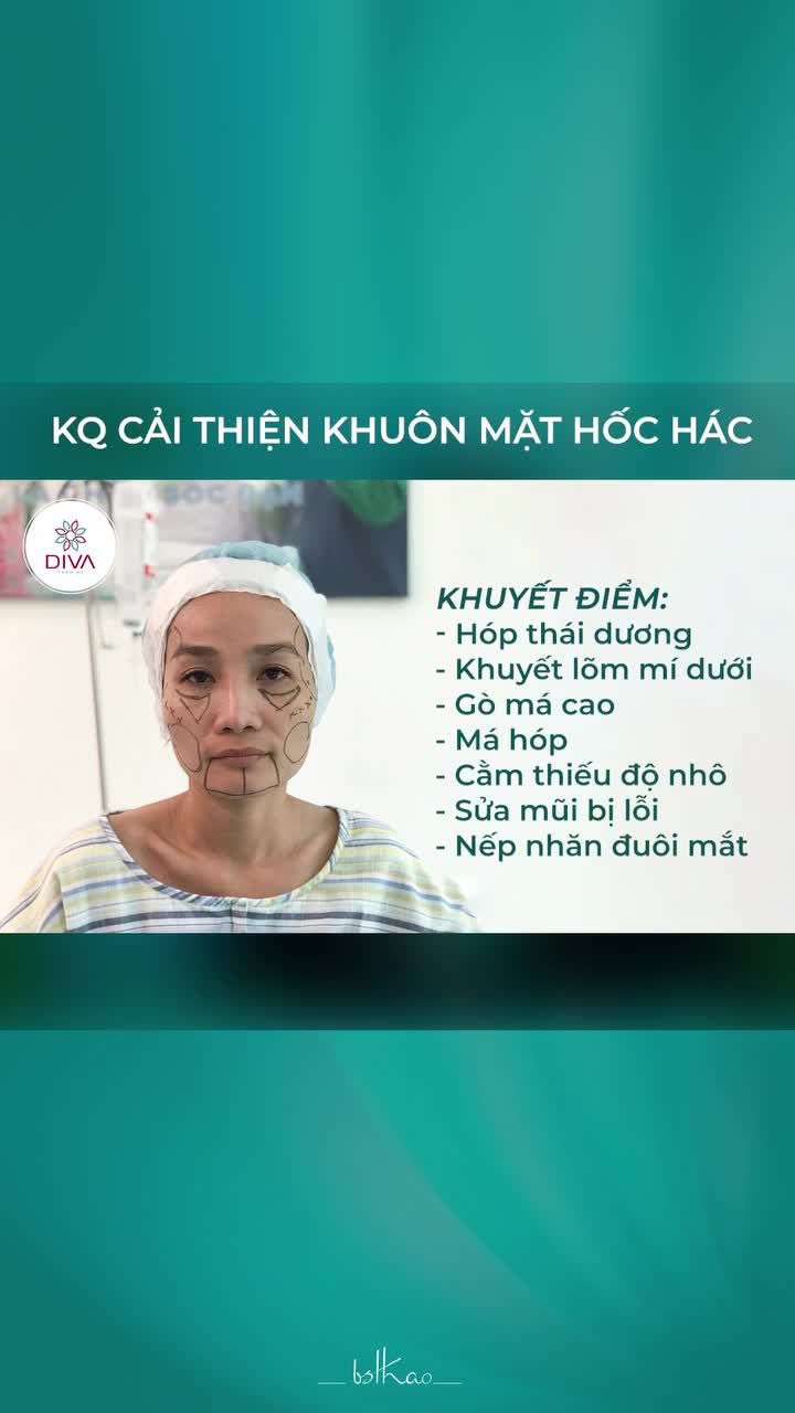 GƯƠNG MẶT HỐC HÁC KÉM THU HÚT, THIẾU NỮ TÍNH SAU CẤY MỠ MẶT, NÂNG MŨI, TIÊM BOTOX THAY ĐỔI RA SAO ?