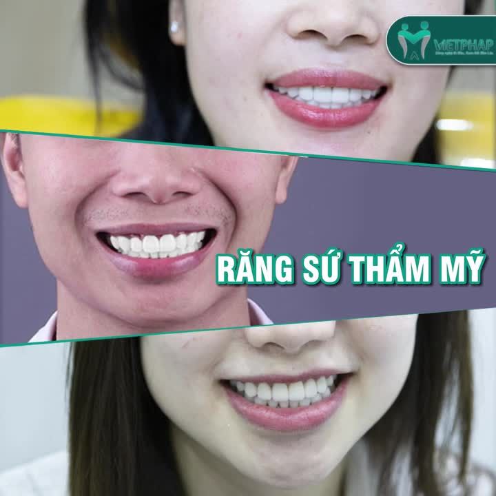 SIÊU SALE RĂNG SỨ THẨM MỸ - ĐẸP KỊP TẾT CHỈ 2 LẦN HẸN