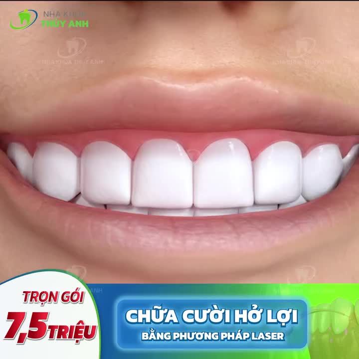 CHỮA CƯỜI HỞ LỢI - ĐẸP NGAY ĐÓN TẾT