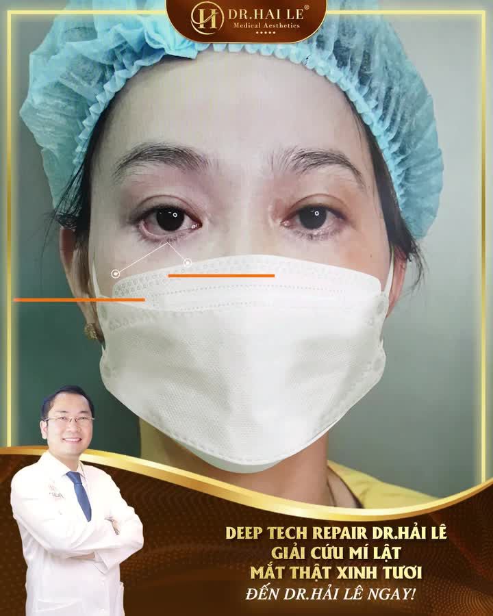Mí dưới sa trễ, lỗi hỏng- Câu chuyện không của riêng ai!