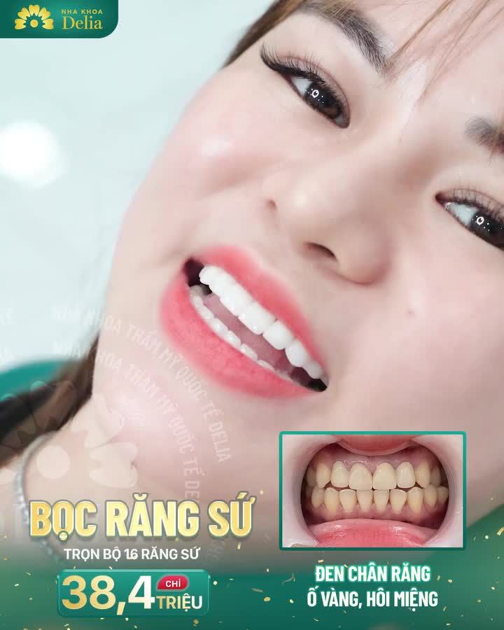 Bọc 20 răng sứ Ceramill  Nụ cười trắng sáng tự nhiên ngay sau 02 buổi hẹn