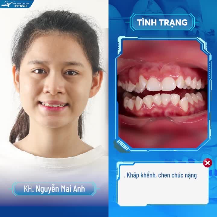 RĂNG KHỂNH CƯỜI DUYÊN? NỮ SINH HỐI HẬN VÌ NIỀNG RĂNG QUÁ MUỘN!