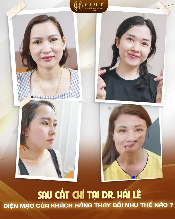 Đây chính là cảm giác của 99,9% khách hàng sau khi thực hiện cắt chỉ - Phẫu thuật đã nhẹ nhàng, cắt chỉ còn nhẹ nhàng hơn nữa!
