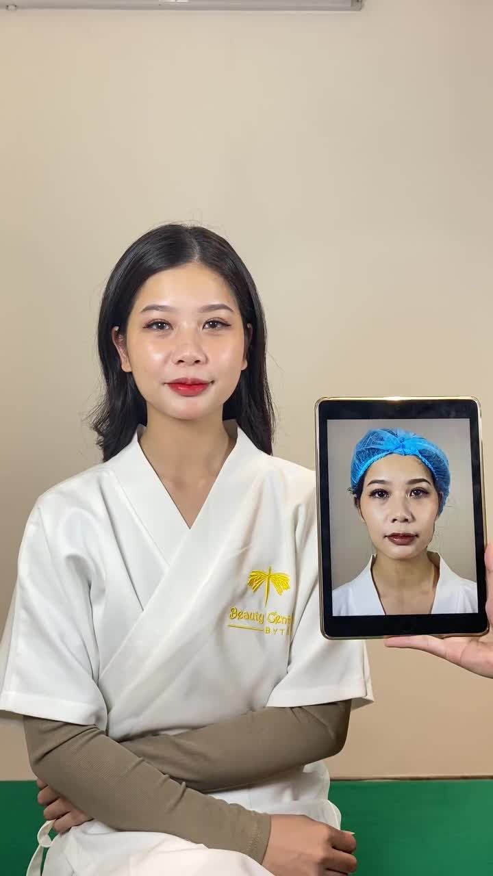 "Làm xong chẳng dám nhìn lại gương mặt của mình trước kia luôn" là chia sẻ của bạn khách ngay sau tiêm FILLER tại Tấm.