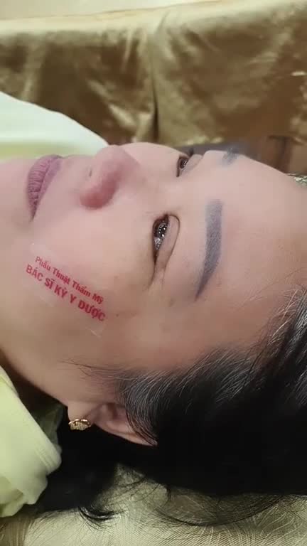 Cắt mí mắt trên - Kỹ thuật đuôi phượng - Loại bỏ da dư, mỡ thừa, treo góc mắt