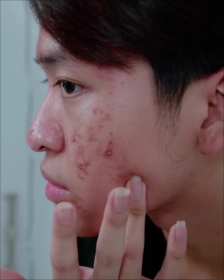 ĐIỀU TRỊ MỤN CHO NAM GIỚI CÓ KHÓ KHÔNG?