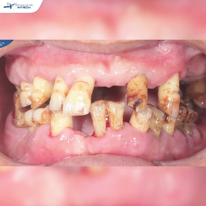 KHÔNG THỂ ĂN NHAI, BỆNH NHÂN TÌM ĐƯỢC PHƯƠNG PHÁP CỨU NGUY THAY ĐỔI CẢ CUỘC ĐỜI