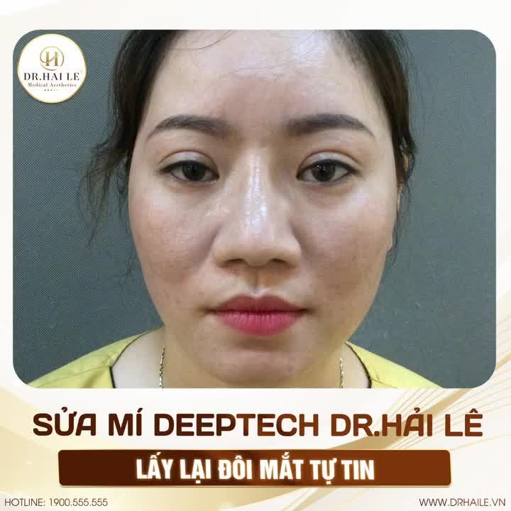 Ô kìa, mới đây nếp mí còn không đều nhau, “mắt bồ câu con đậu con bay”, thế mà chỉ sau 1 GIỜ 30 PHÚT “cửa sổ tâm hồn” đã đẹp rạng rỡ, không còn dấu vết của mí lỗi, hỏng!