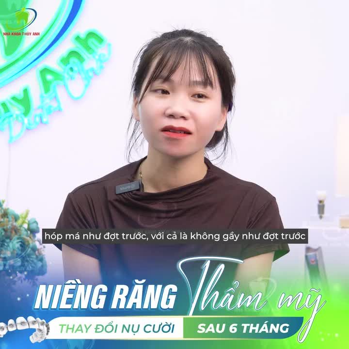 GIẢM HÔ, CƯỜI XINH - SỰ THAY ĐỔI SAU 6 THÁNG NIỀNG RĂNG