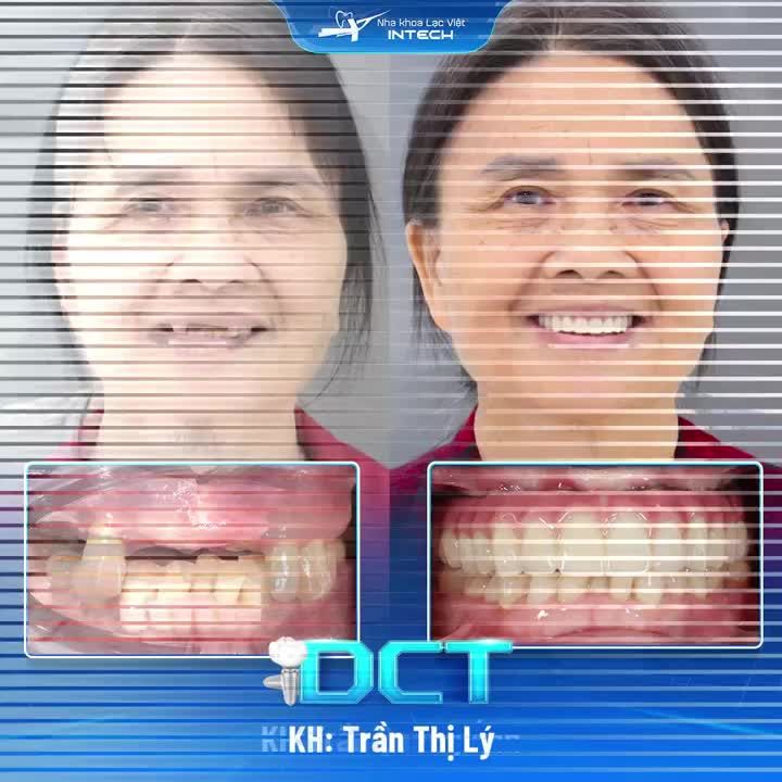 CÔNG NGHỆ DCT CÓ VAI TRÒ NHƯ THẾ NÀO TRONG THÀNH CÔNG CỦA CA TRỒNG RĂNG IMPLANT?