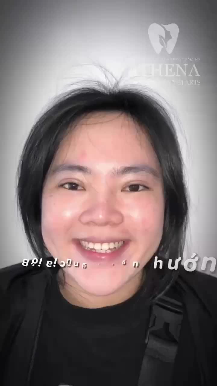 Chúc mừng Nương A Lan đã hoàn tất chặng đường chăm sóc răng tại Nha Khoa ATHENA với sự kiên trì và nỗ lực phi thường!