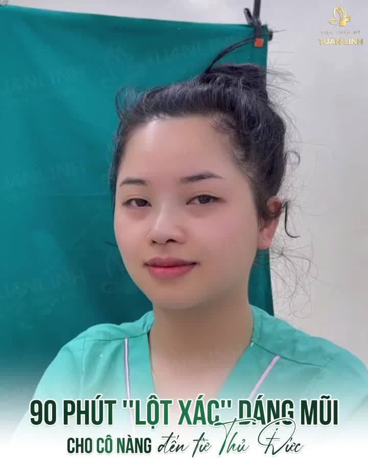 Gạt phăng nỗi sợ, sau 90 phút nâng mũi tại Tuấn Linh, khách hàng đã sở hữu dáng mũi đẹp như mơ, "lột xác" hoàn toàn gương mặt, xinh đẹp sắc nét hơn rất nhiều.