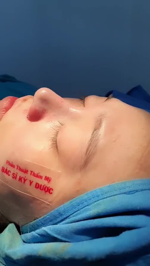 KẾT QUẢ CA NÂNG MŨI ALINE ĐẸP TRONG HÔM NAY