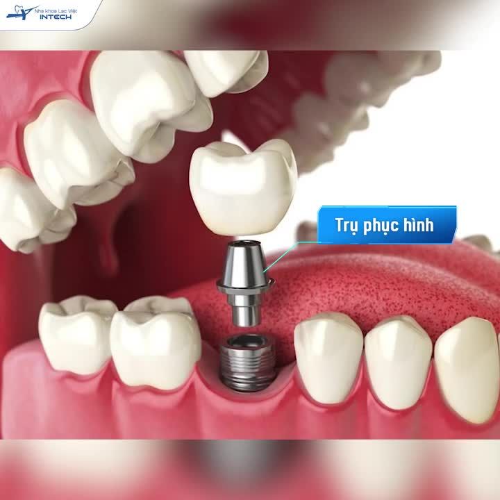 TRỤ PHỤC HÌNH CÁ NHÂN HÓA CÓ VAI TRÒ NHƯ THẾ NÀO TRONG TRỒNG RĂNG IMPLANT?