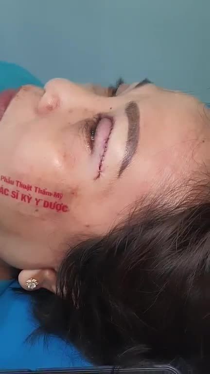 Chị khách tới trung tâm với đôi mắt 1 mí, không đồng đều, da dư che nếp mí. Đặc điểm này khiến chị trông đứng tuổi hơn nhiều.