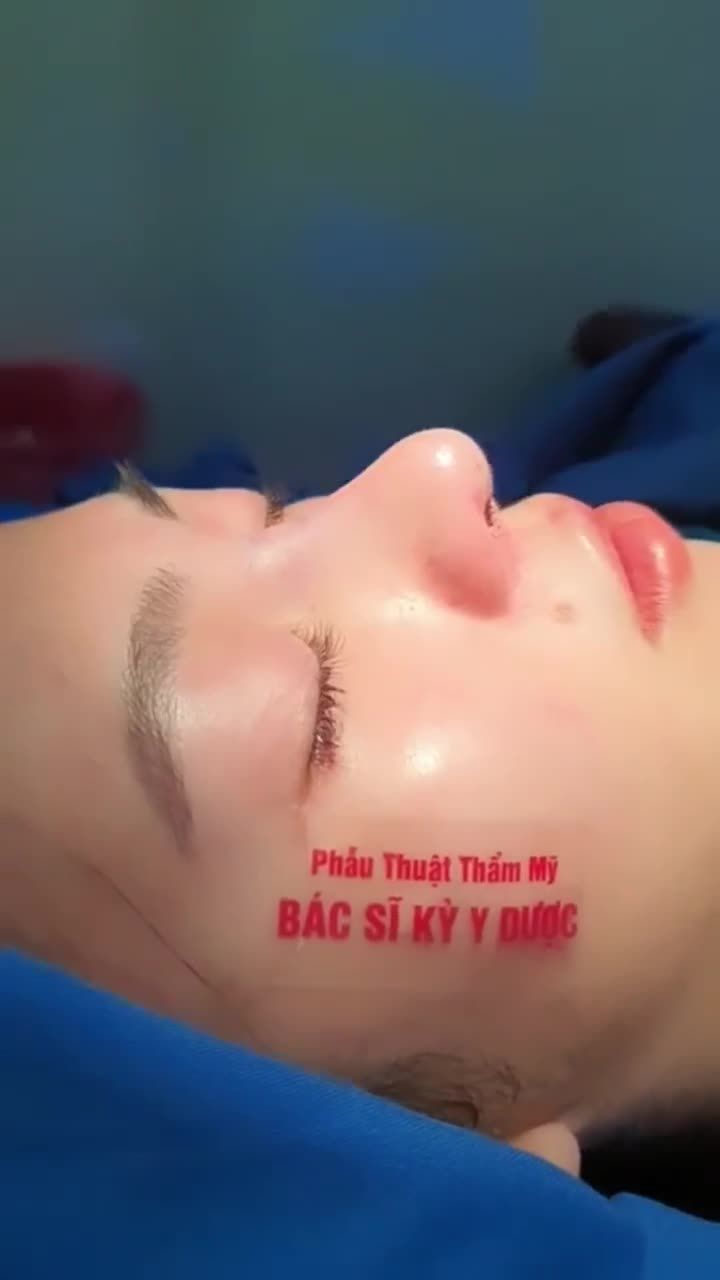 CẢI THIỆN HOÀN TOÀN DÁNG MŨI VỚI NÂNG MŨI ALINE