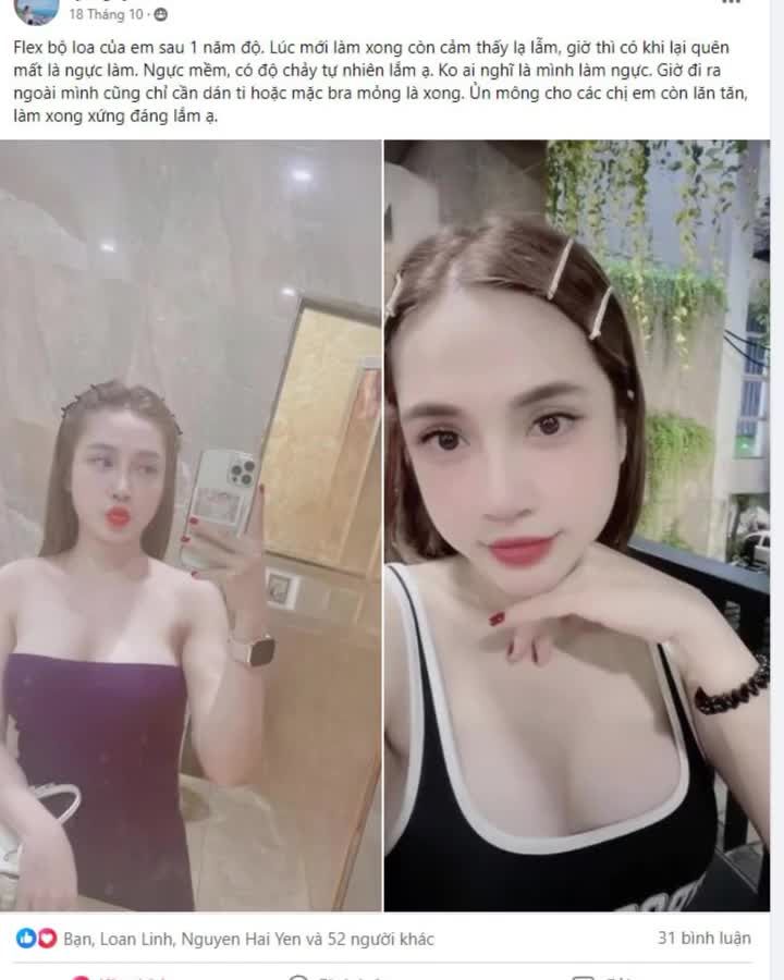 Review chân thực từ khách hàng sau 1 năm nâng ngực.