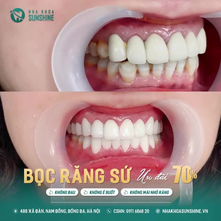 CHINH PHỤC NỤ CƯỜI HOÀN HẢO NHẤT VỚI CHI PHÍ TỐT NHẤT