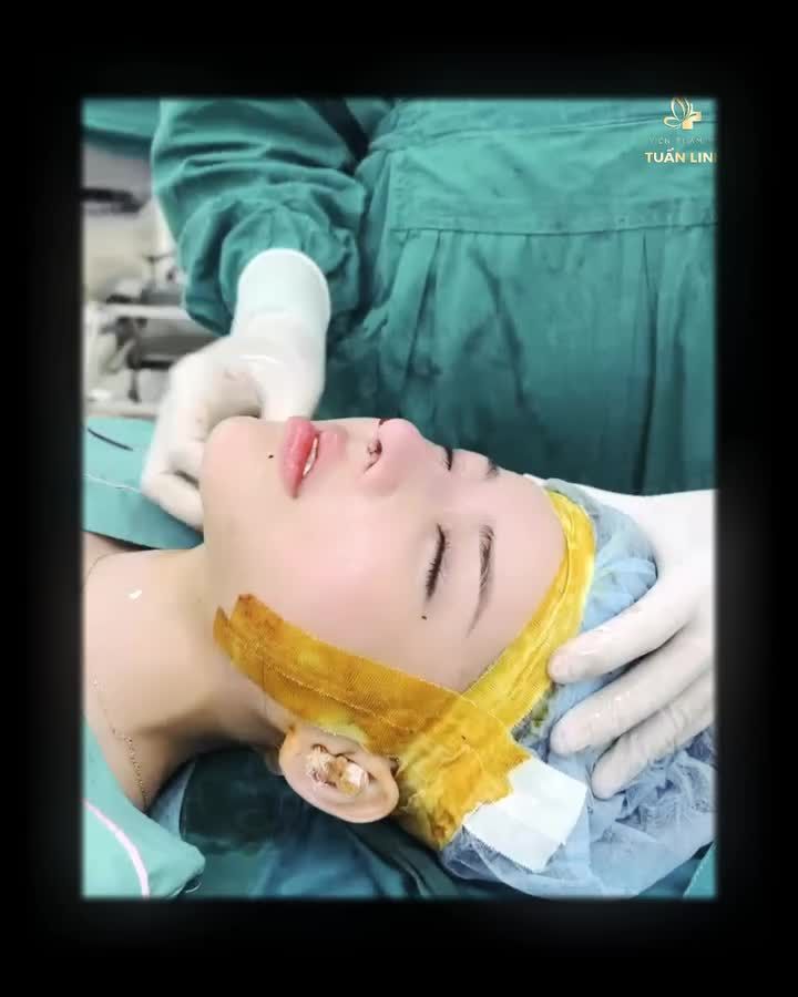 Xem đến cuối Clip để thấy sự khác biệt trước và sau khi nâng mũi sửa lại!!