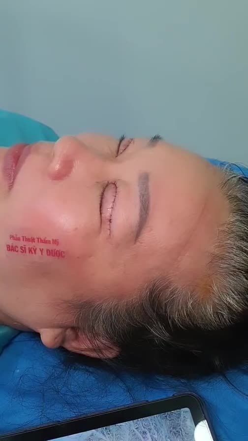 Cắt tạo mí đôi, nếp mí đều đẹp, rõ nét - Loại bỏ da dư, mỡ thừa vùng mí mắt trên - Mang lại sự trẻ trung tươi vui cho đôi mắt - Đường khâu thẩm mỹ, siêu mảnh. Khi cắt chỉ sẽ không để lại sẹo. - Phẫu thuật không đau.