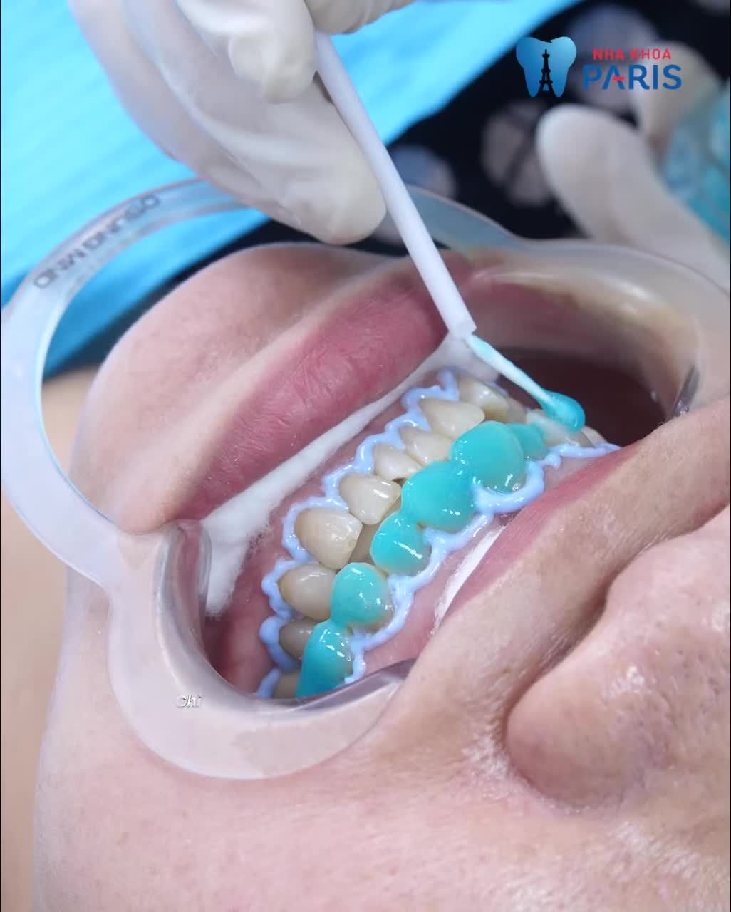 Tẩy trắng răng siêu ưu đãi đón Giáng sinh - 2̶5̶0̶0̶K̶ -> 1499K