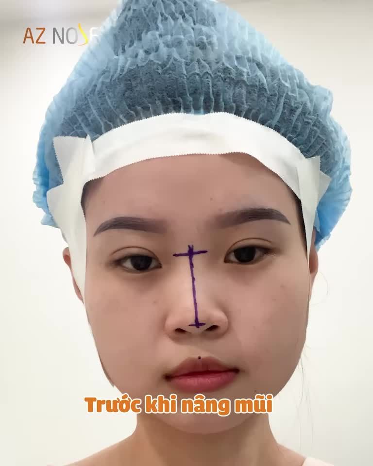 "Người người nhà nhà" chọn nâng mũi cận Tết vì điều gì?