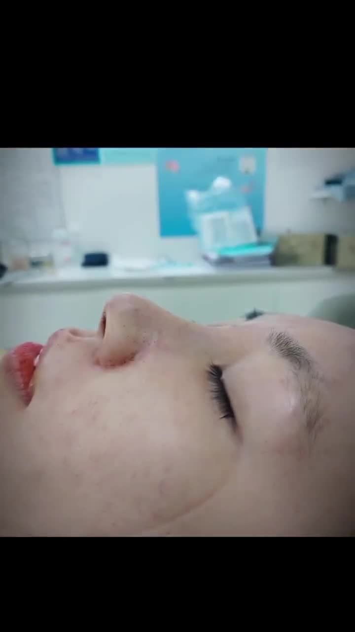 Nhan sắc thăng hạng sau khi nâng mũi tại Thiện Mỹ