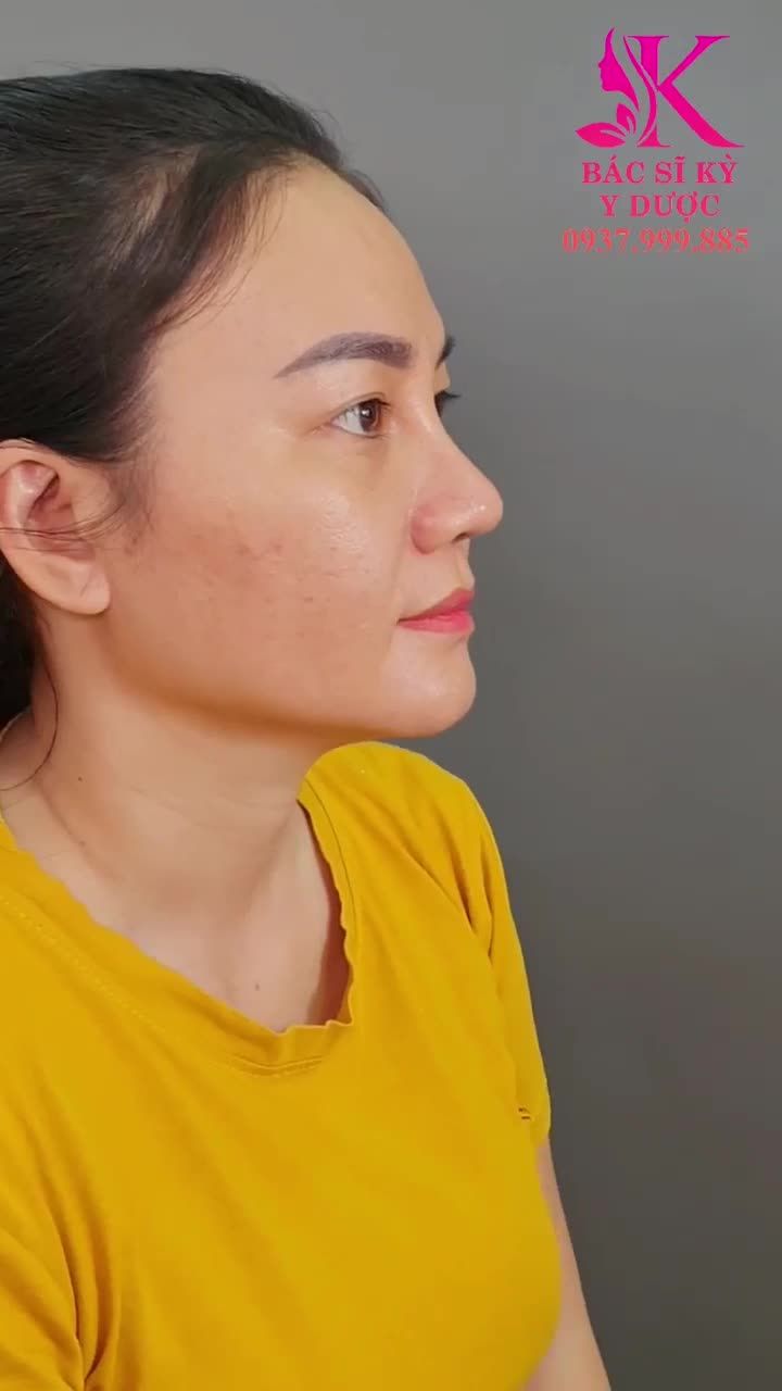 MỘT PHIÊN BẢN HOÀN TOÀN KHÁC SAU NÂNG MŨI ALINE