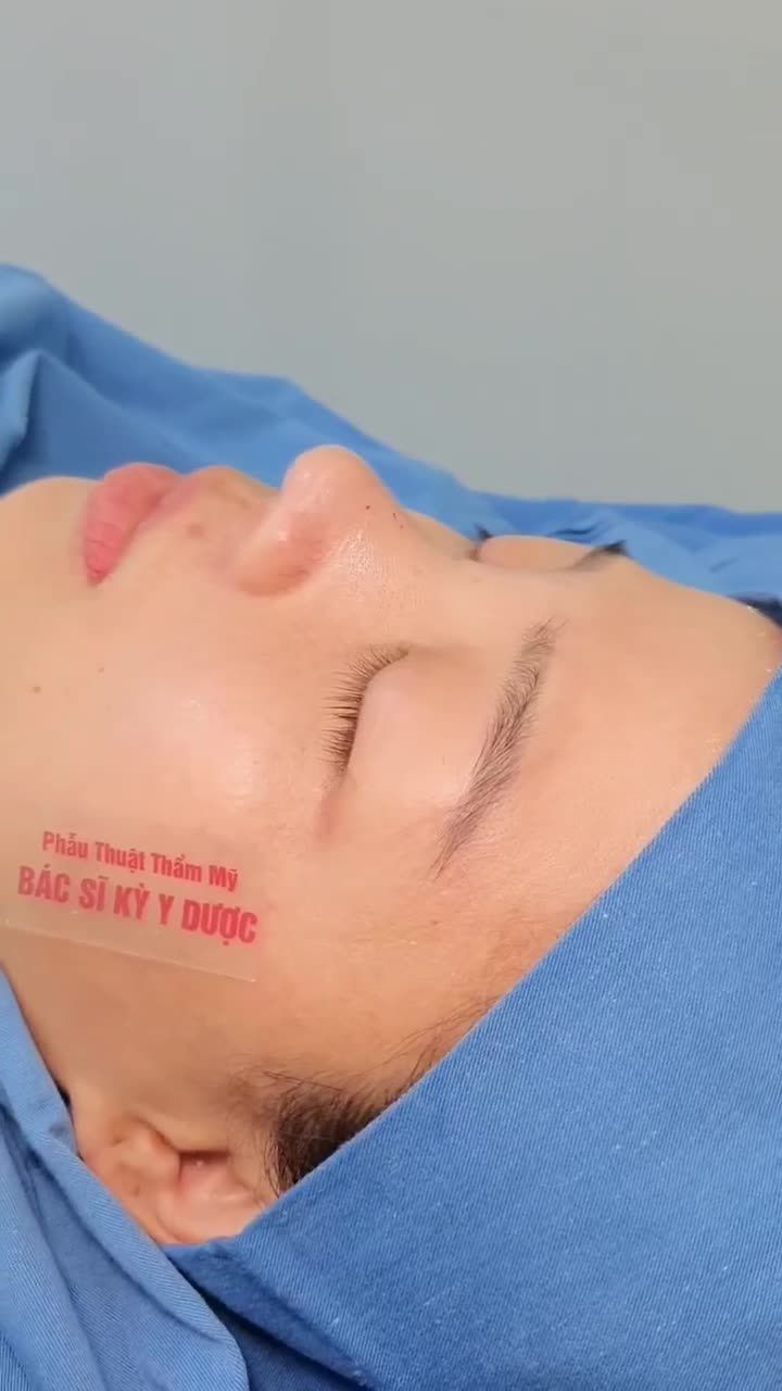 NÂNG MŨI BAY CAO - THANH THOÁT GƯƠNG MẶT
