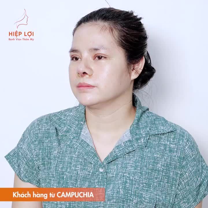 Chị khách đến từ CAMPUCHIA với lựa chọn thực hiện Combo cắt mí, nâng mũi để gương mặt trở nên hài hòa và đẹp hơn.