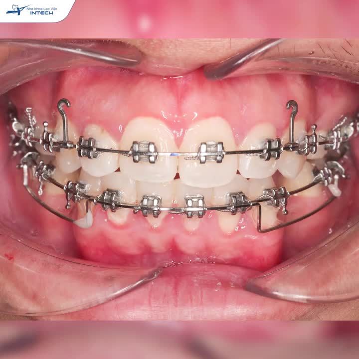 HẾT KHẤP KHỂNH, GIẢM HÔ RÕ RỆT SAU 1 NĂM NIỀNG RĂNG