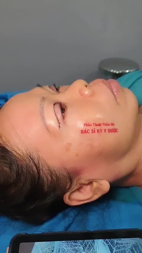 CẮT MẮT MÍ TRÊN PLASMA - LOẠI BỎ MÍ SỤP, TẠO MÍ TỰ NHIÊN