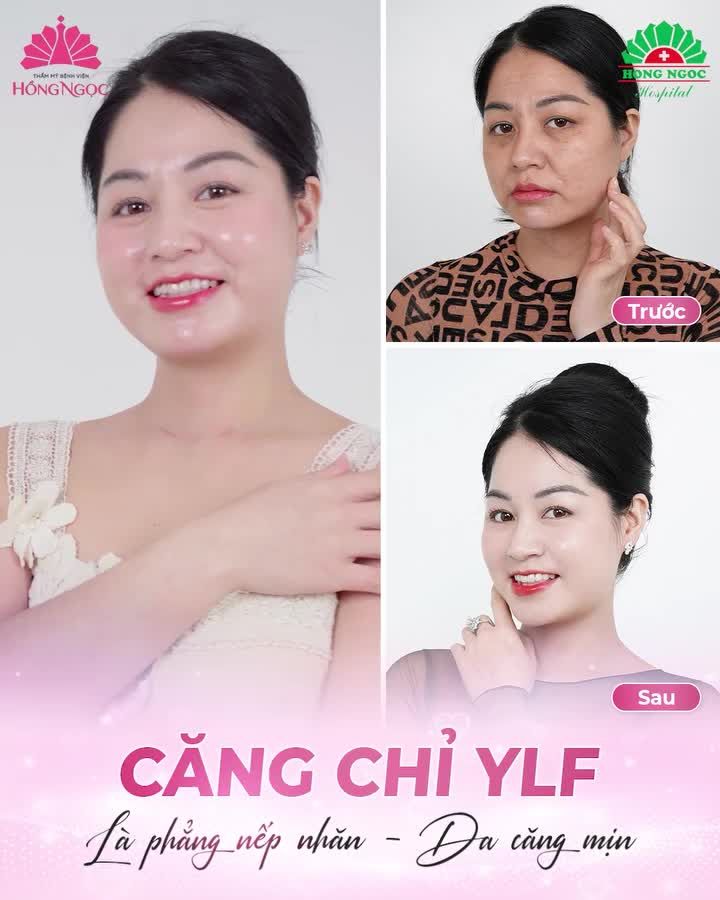 ĐI TÌM BÍ QUYẾT TRẺ HÓA XÓA NHĂN CHO CHỊ KH 45T