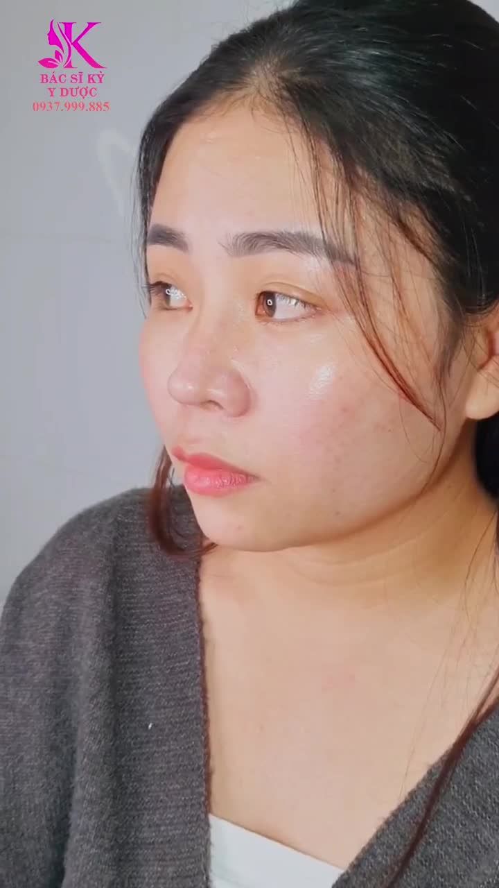 THẢ NHẸ KẾT QUẢ SAU NÂNG MŨI ALINE ĐẸP XUẤT XẮC